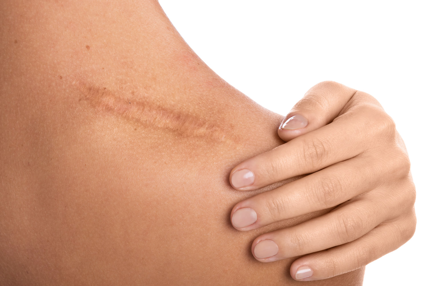 Woman with a scar on her shoulder